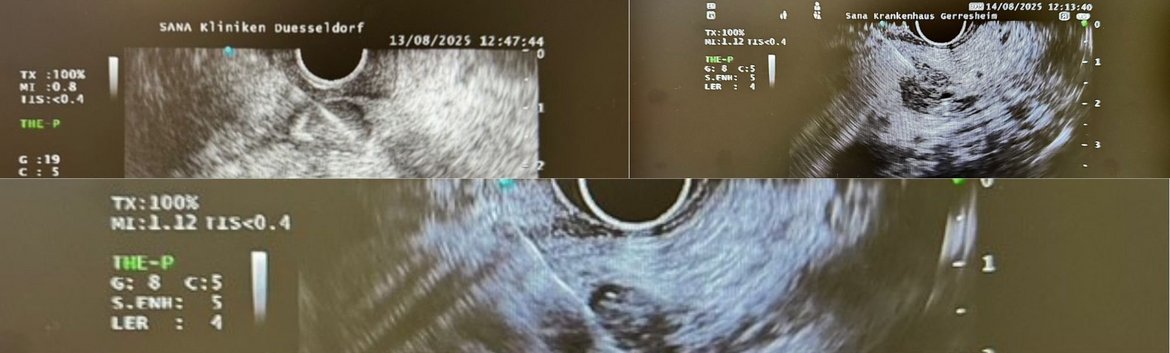 Sana Newsletter Benrath- endosonographische FNP von unklaren Raumfoderungen im Pankreas