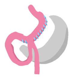 Single Anastomosis Sleeve Ileal Bypass Single Anastomosis Sleeve Ileal Bypass