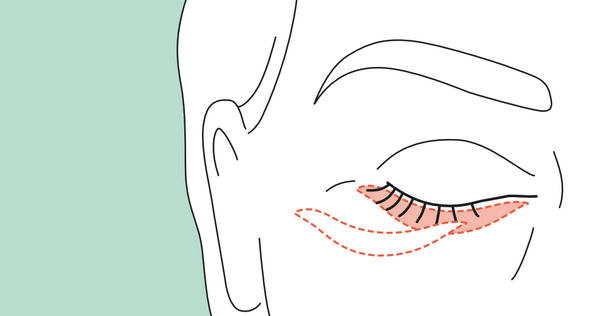 Entfernung der überschüssigen Haut Unterlid